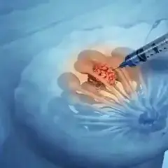Biopsja piersi - ile trzeba czekać na wyniki i co wpływa na czas?