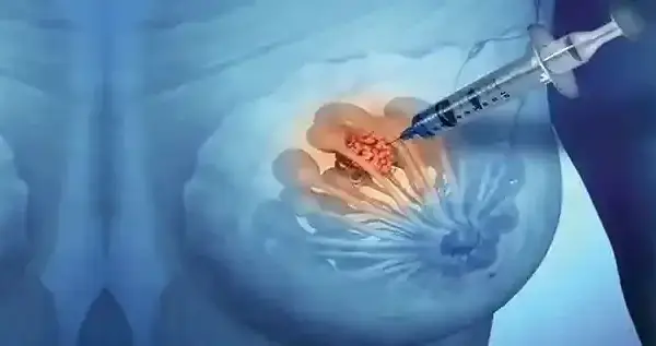 Biopsja piersi - ile trzeba czekać na wyniki i co wpływa na czas?